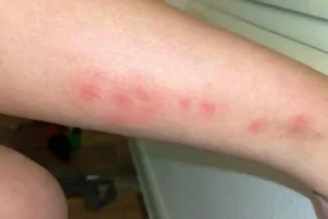 No Signs of Bed Bugs but I Have Bites